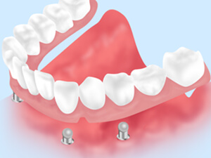 インプラントオーバーデンチャー