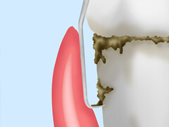歯石除去（スケーリング）