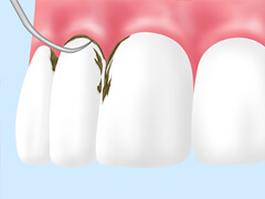 歯石除去（ルートプレーニング）
