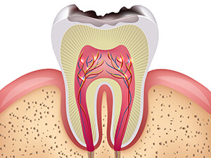 虫歯にはどうしてなるの？