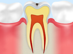 【C0】初期の虫歯