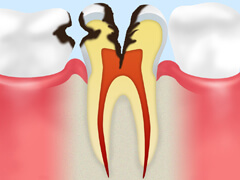 【C3】神経の虫歯