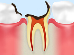 【C4】歯根の虫歯