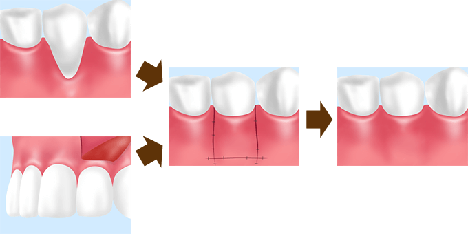 歯肉移植